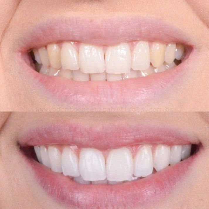 FlashWhite™ - Blanchiment dentaire rapide & Sourire éclatant